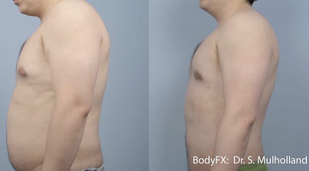 BodyFX Body Contouring Vaughan Enriched Med Spa