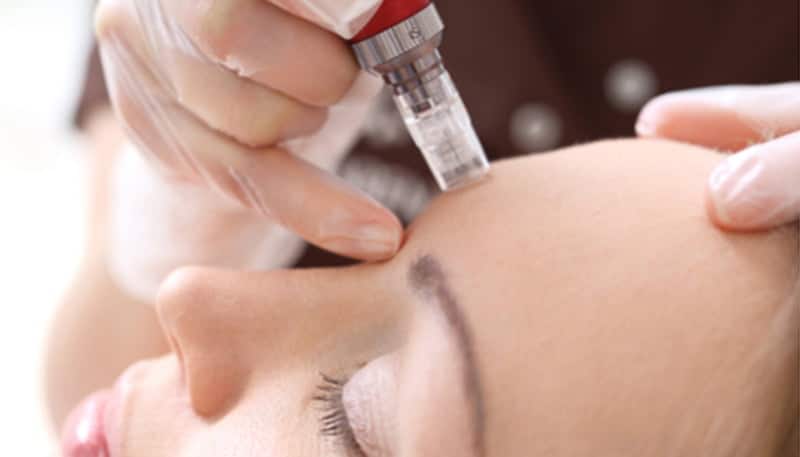 What Micro-needling Really Does to Your Face