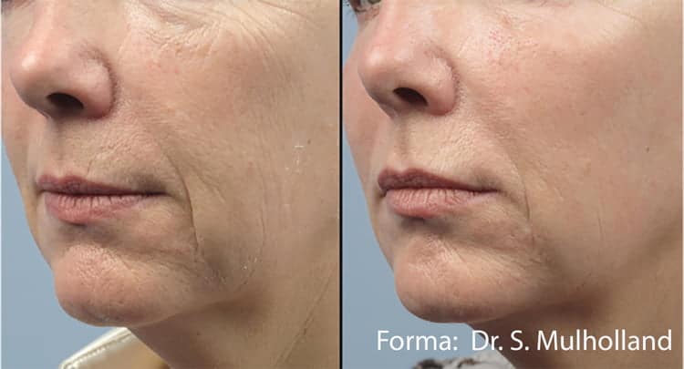 Forma - Face Lift