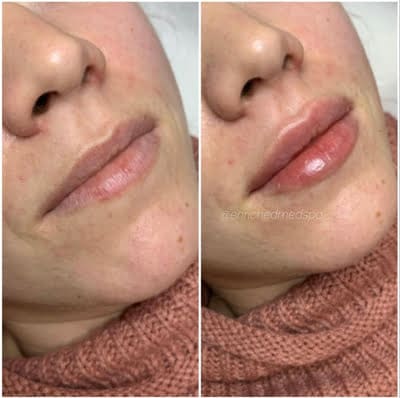 BodyFX Filler Before & After Dermal fillers Vaughan