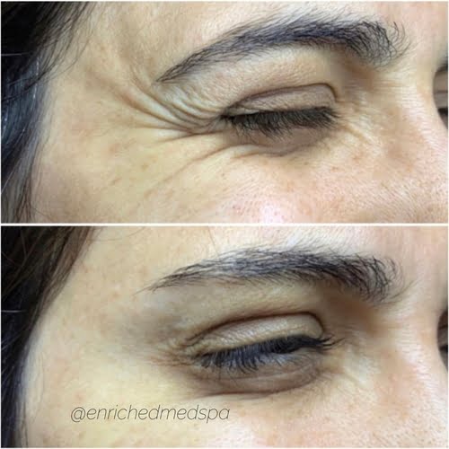 Botox Image Before & After