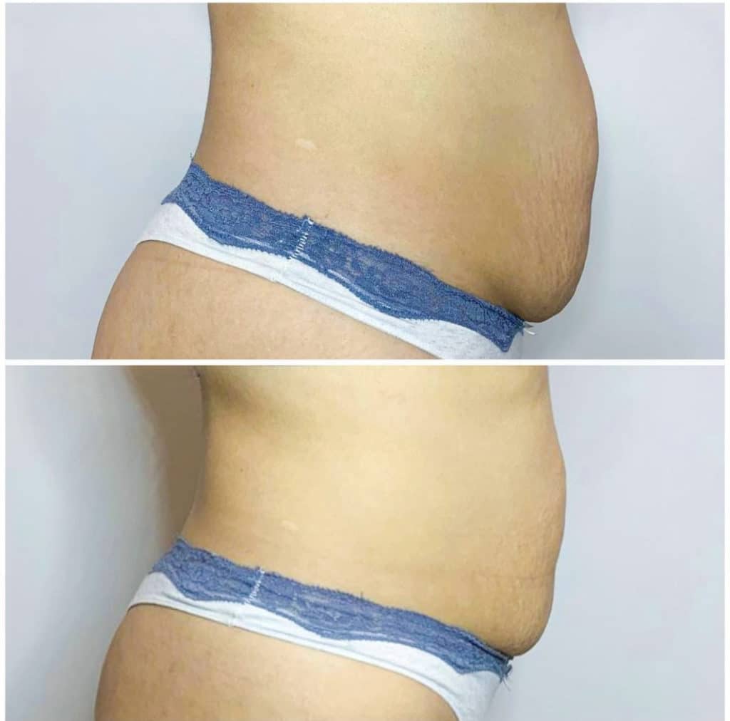 Stomach BdoyFX Before and After Results