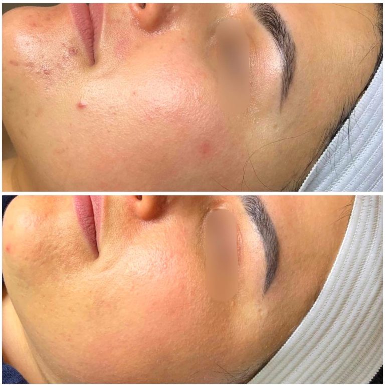 Microneedling PRP Vampire Facials | Facials Vaughan | Botox Vaughan