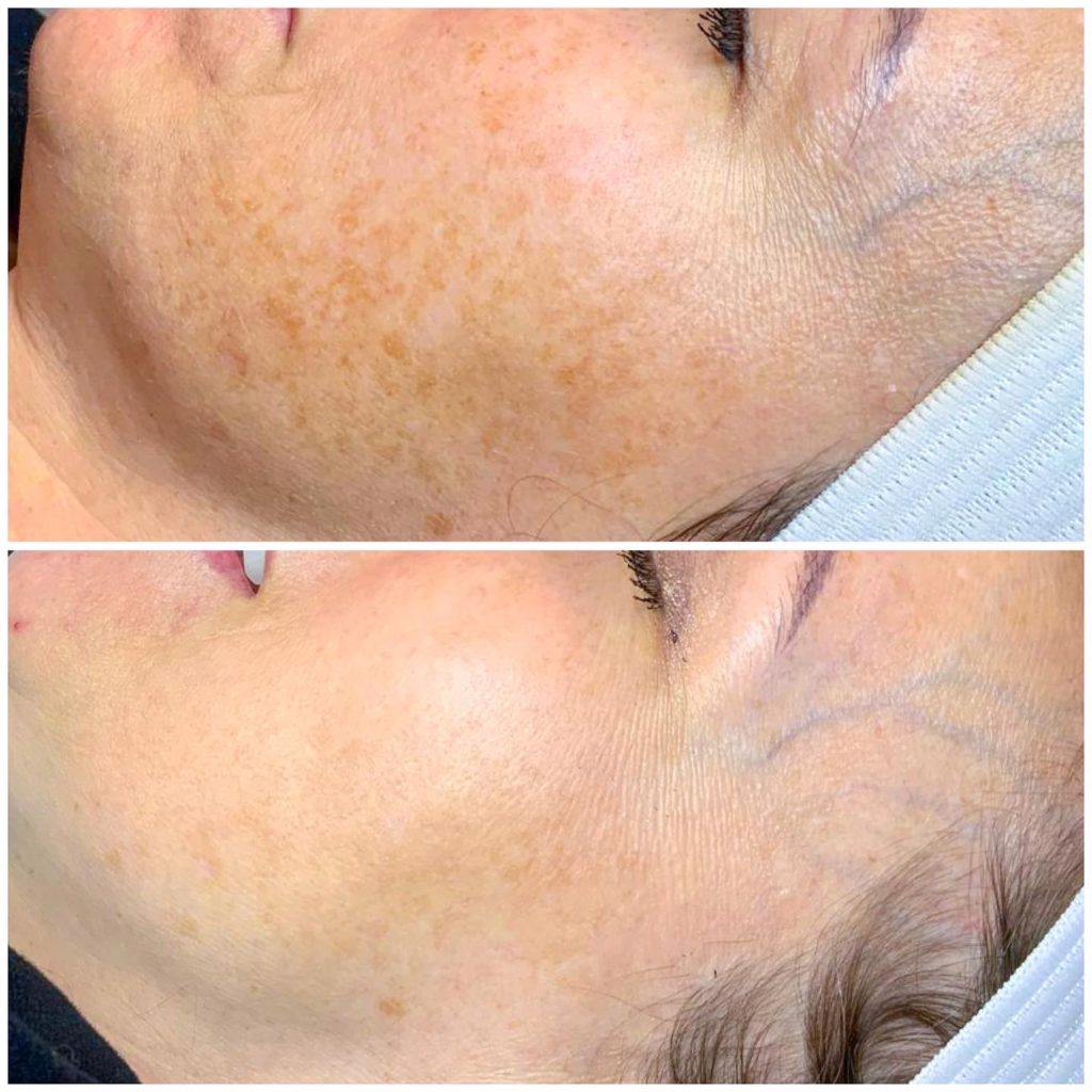 close up photo of IPL before and after treating hyperpigmentation