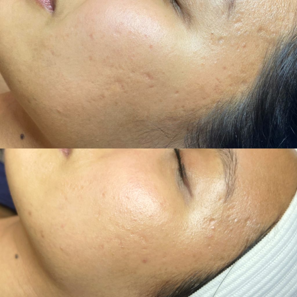close up photo of acne scars treatment results