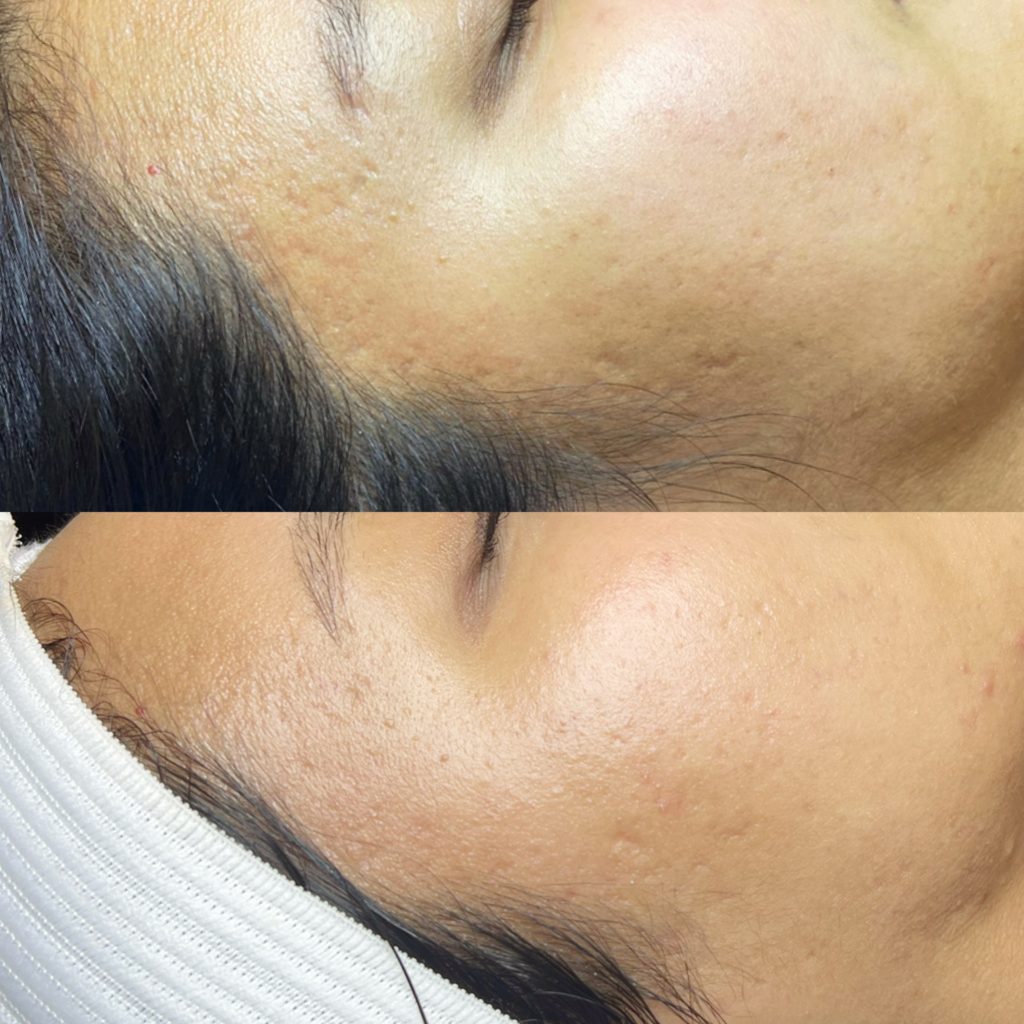 close up photo of acne scars treatment results