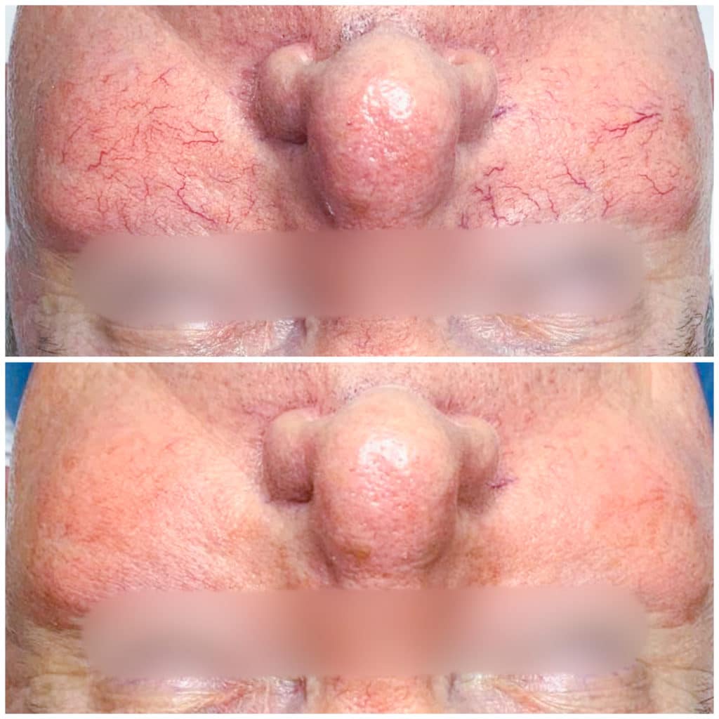 close up photo of IPL before and after for broken capillaries