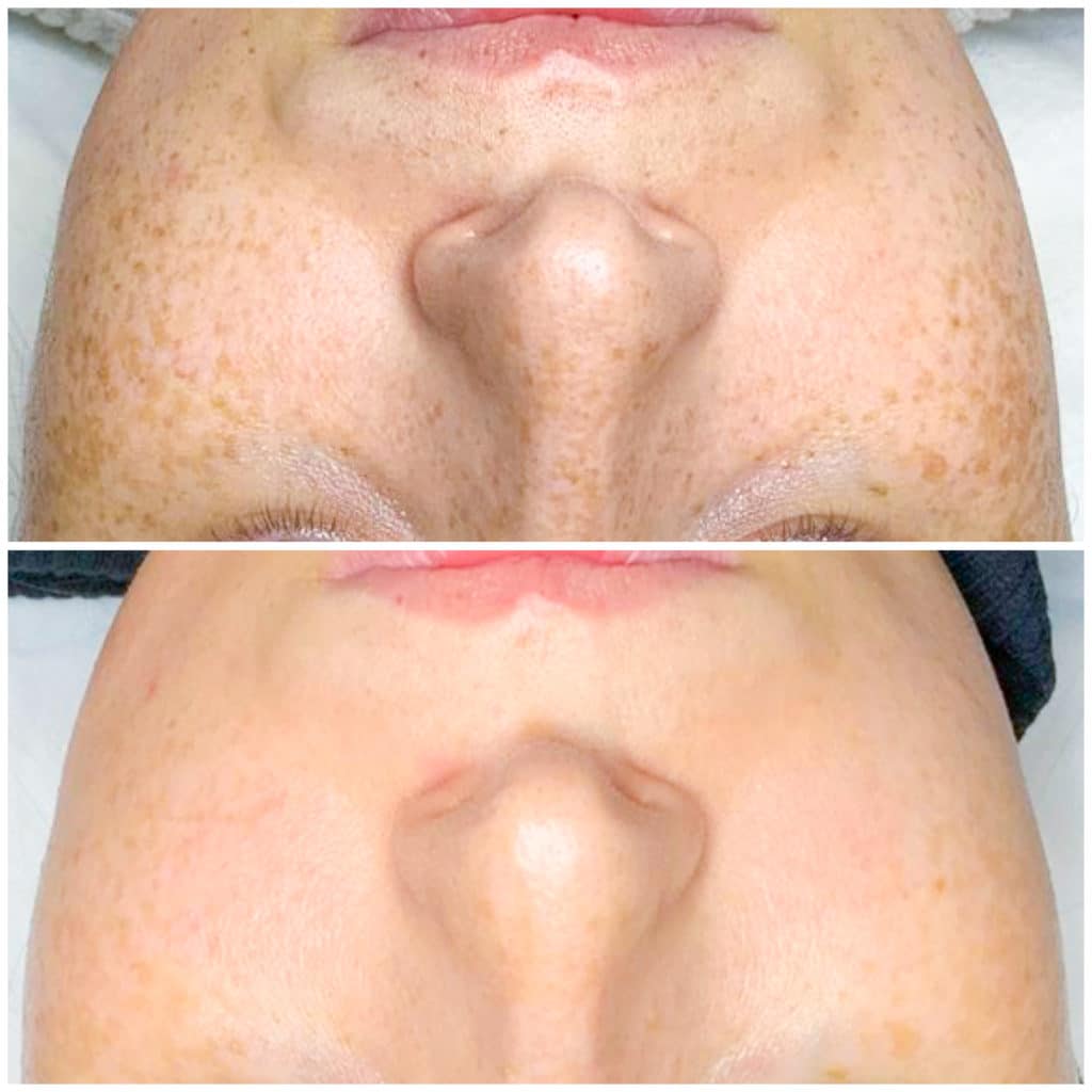 close up photo of an IPL treatment before and after 2 treatments