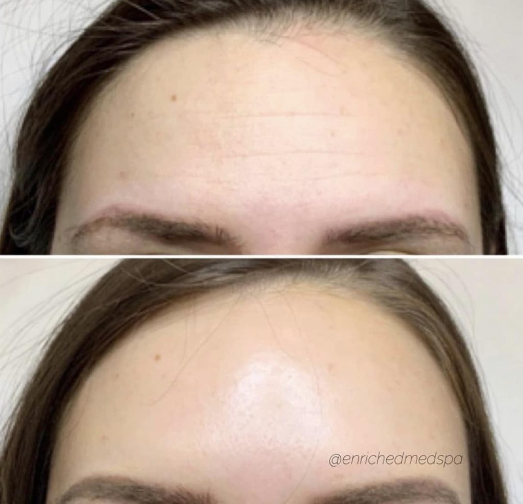 Botox Before and After Clinic Near Me