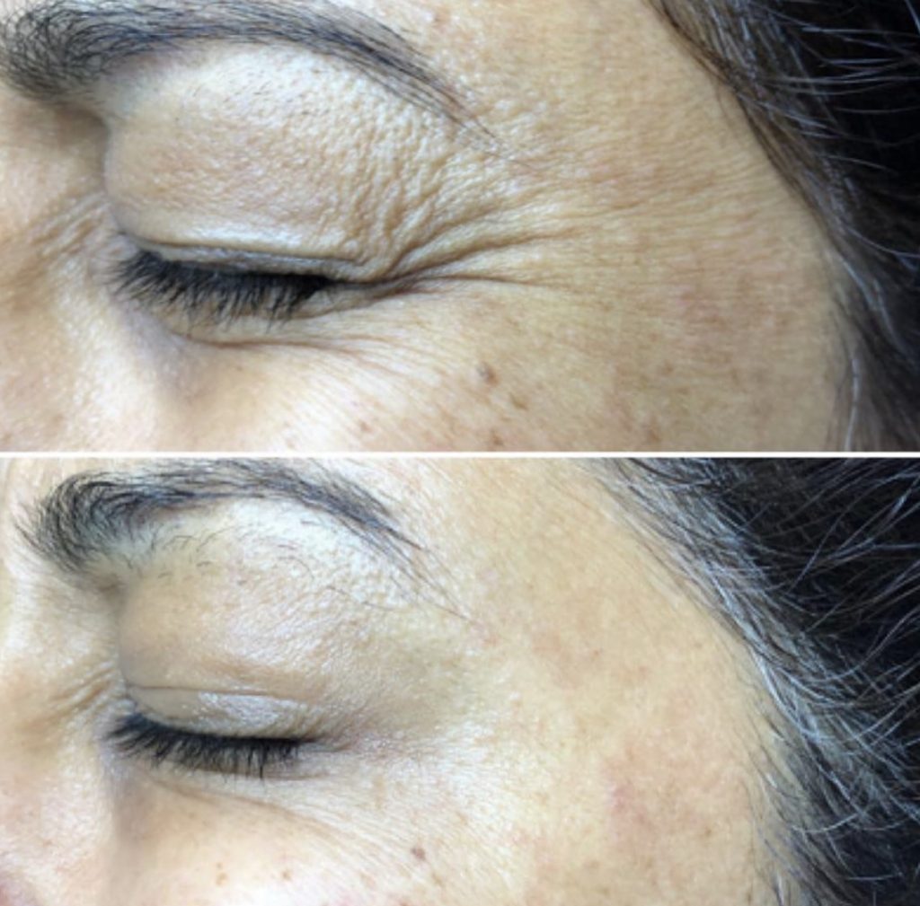 Botox Clinic Crows Feet before and after Clinic Near Me