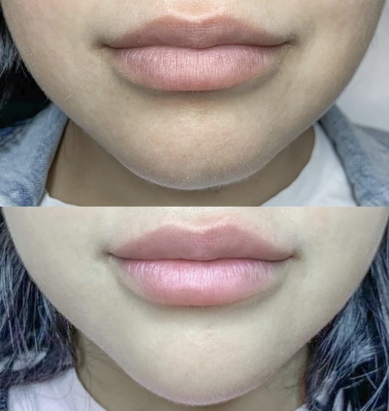 Dermal Fillers Near Me Before and after Woodbridge