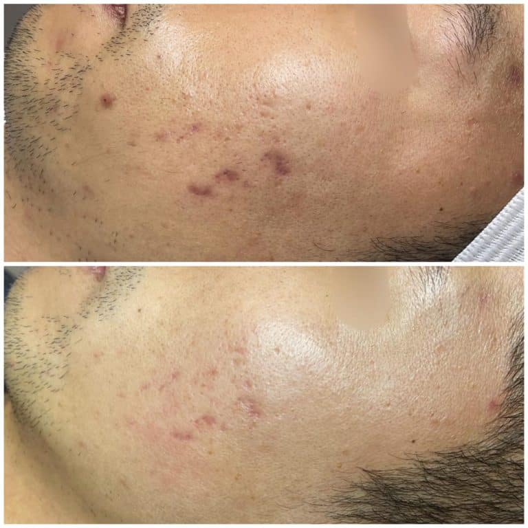 Close up of peel results of hyperpigmentation