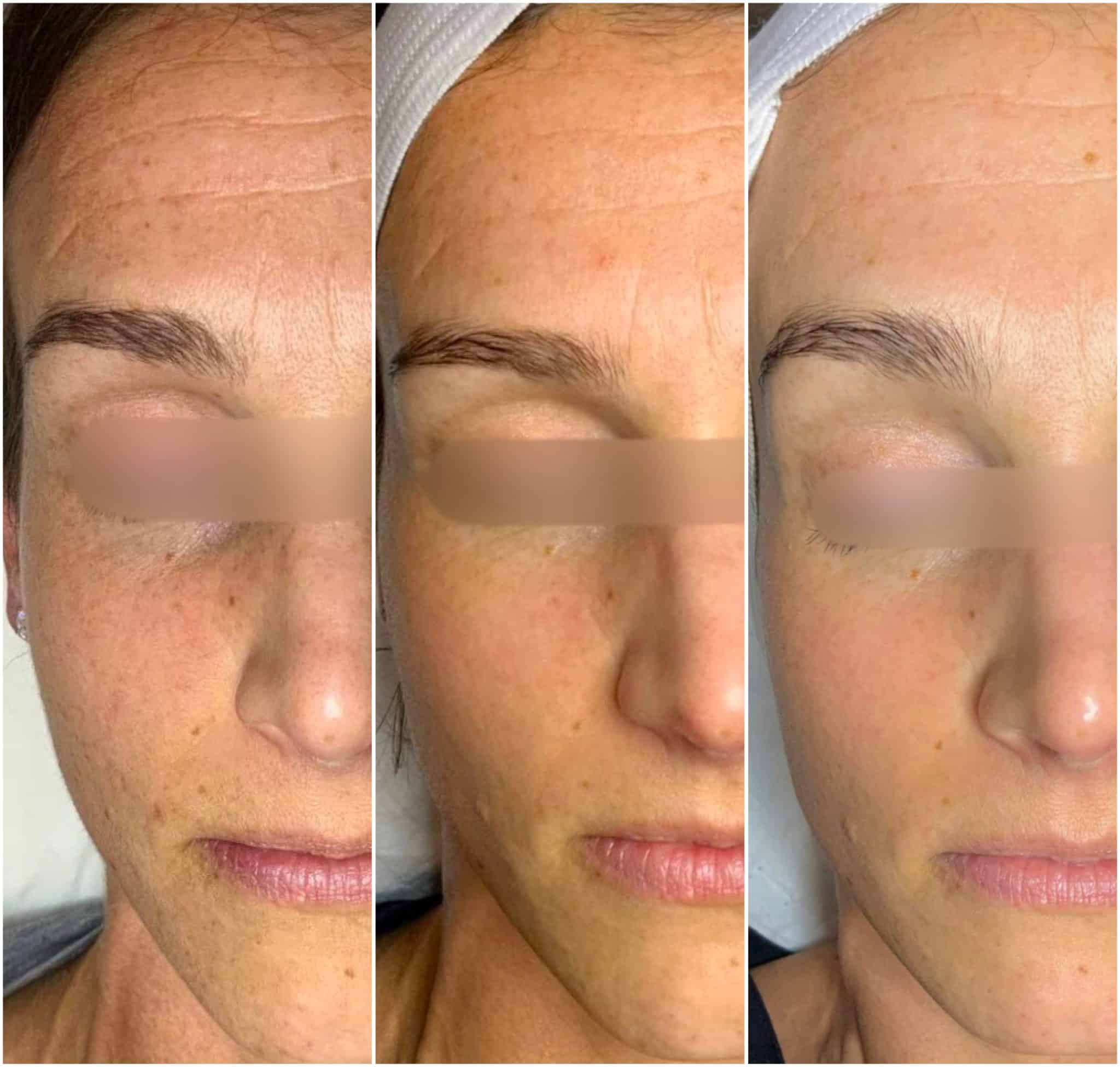 Tetra Co2 Laser Cool Peel At Enriched Vaughan