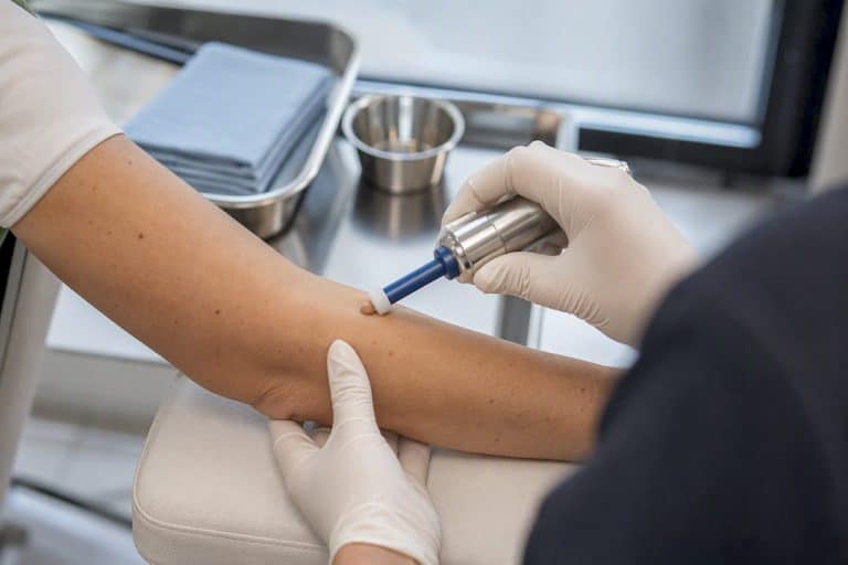 Clinician performing skin tag removal