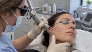 Clinician performing fractional CO2 scar resurfacing