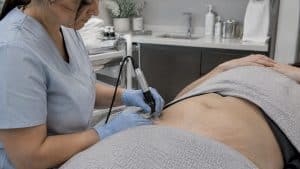 Microneedling treatment on stretch-marked skin